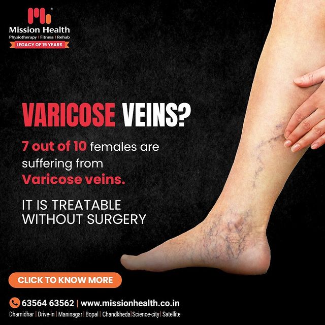 Varicose veins are more common in women due to prolonged standing hours, Pregnancy or hormonal imbalance. However, there is effective treatment available without surgery to recover from varicose veins.

For more details, 📞 +91 63564 63562 or visit: www.missionhealth.co.in

#MissionHealth #MissionHealthIndia #MovementIsLife #varicoseveins #spiderveins #veintreatment #veins #spiderveintreatment #veinremoval #vascularphysiotherapy #varicoseveintreatment #veindoctor #varices #veinclinic #varicose #healthylegs #health #legveins #varicoseveins